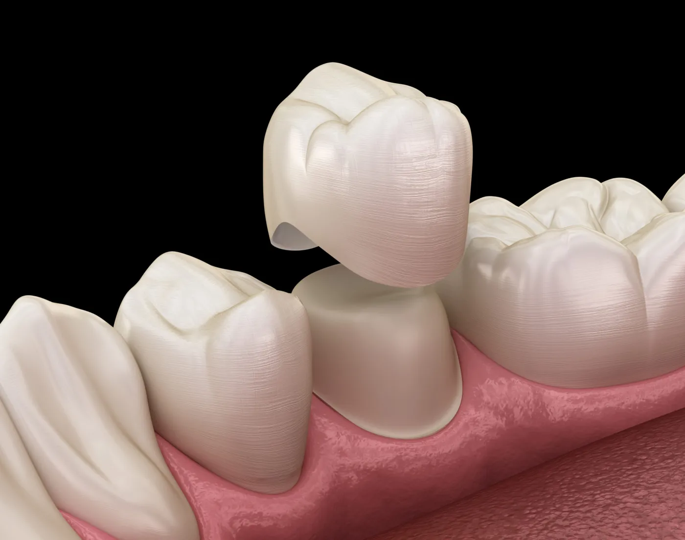 Cât durează o coroană dentară?