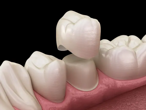 Cât durează o coroană dentară?